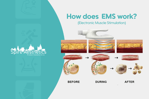 EMS treatment for post pregnancy weight loss treatment England