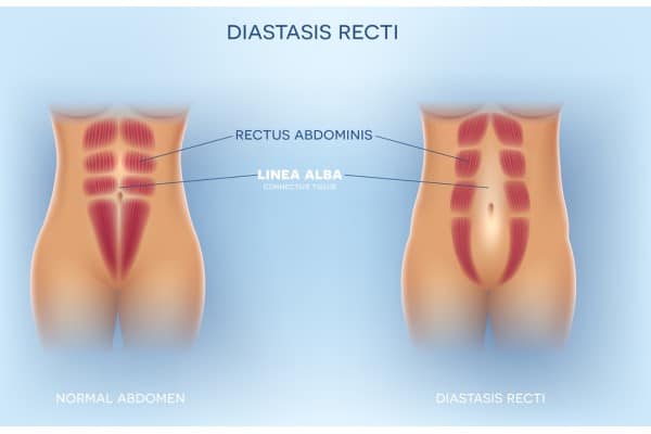 What Non-Surgical Options Are Available for Diastasis Recti England?