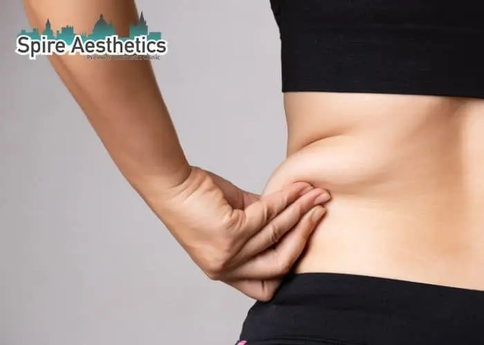 Image of woman pinching fat on their hips England. Fat Freezing treatment
