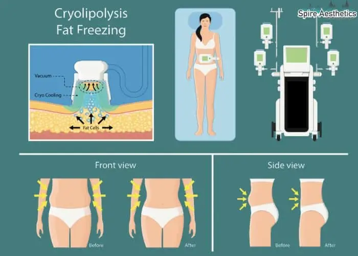 Fat freezing treatment England benefits for competitions to remove stubborn fat deposits.