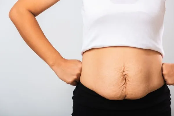 Image of a woman's stomach after weight loss with sagging skin following a gastric band England
