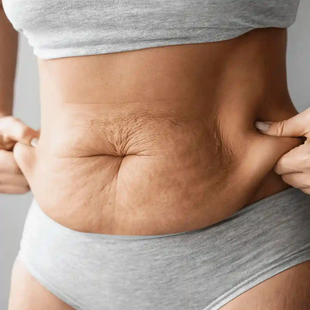 Is It Normal to Have Loose Skin After Pregnancy England?