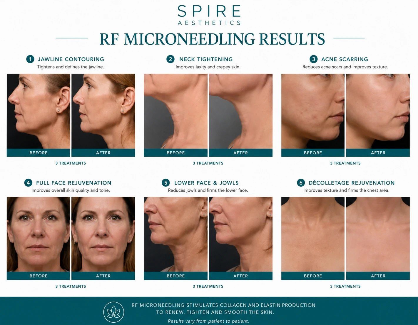 RF Microneedling Skin tightening England results