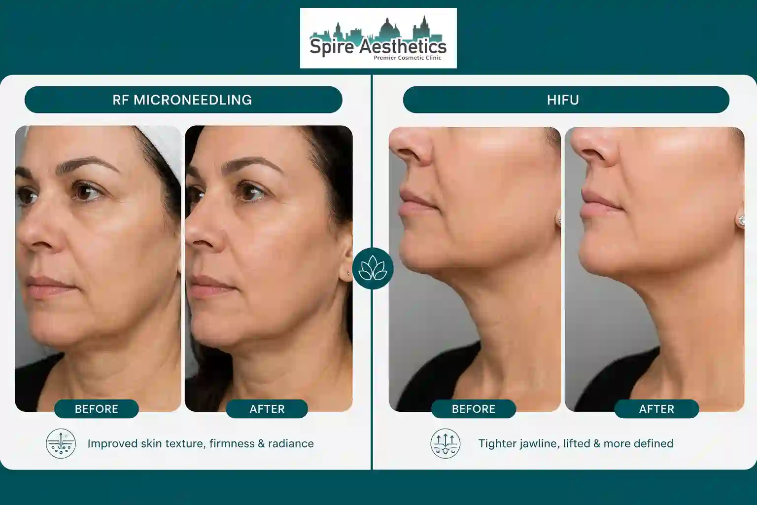 Can RF Microneedling and HIFU Be Combined England?