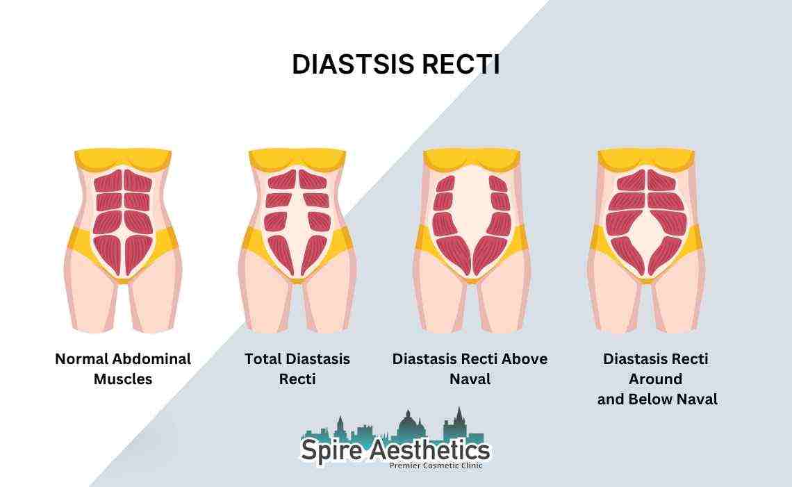 Is Non-Surgical Diastasis Recti Treatment Right for You? Common Concerns Answered England